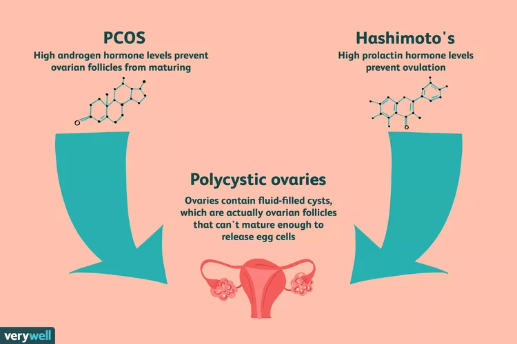 Hypothyroidism and PCOS